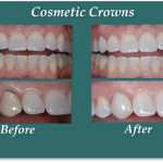 Cosmetic Crowns